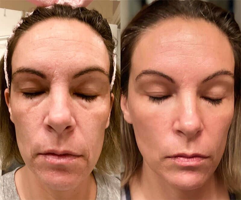 Before-and-after photos of a person who has undergone several sessions of Light Therapy Facial-X7,